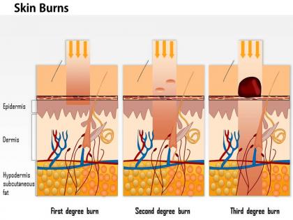 0914 skin burns medical images for powerpoint